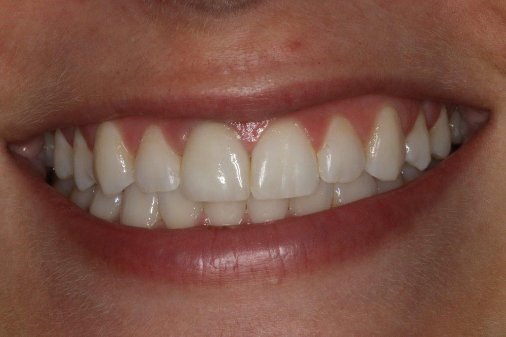 Porcelain crowns and tissue contouring - Lake Area Dental