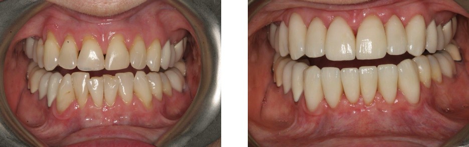 Orthodontics & Crowns