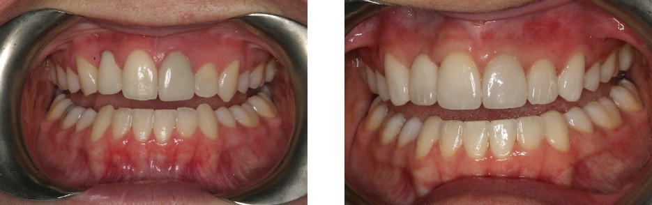 Front six teeth were restored with porcelain crowns