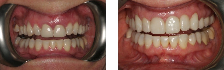 Orthodontics, Implant & 6 Crowns