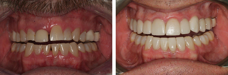 Orthodontics, Crowns & Implan