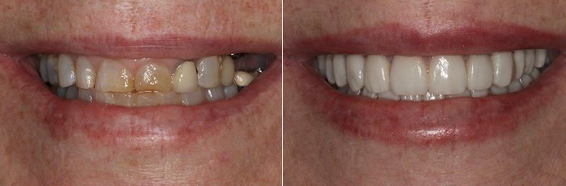 smile-before-after