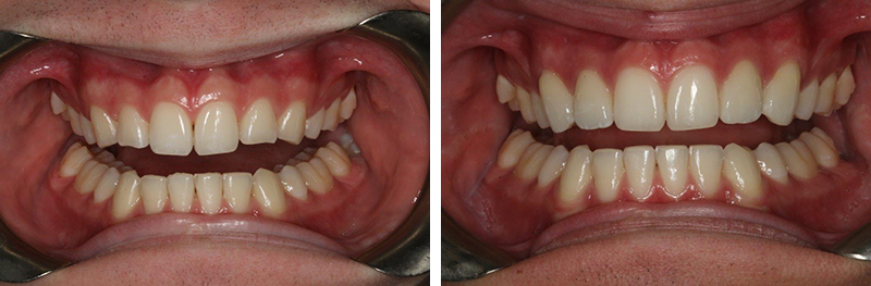 Crowns and Shaping teeth