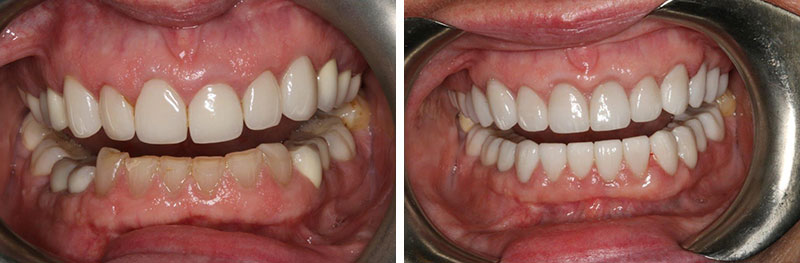 Full Mouth Rehabilitation with Crown Lengthening