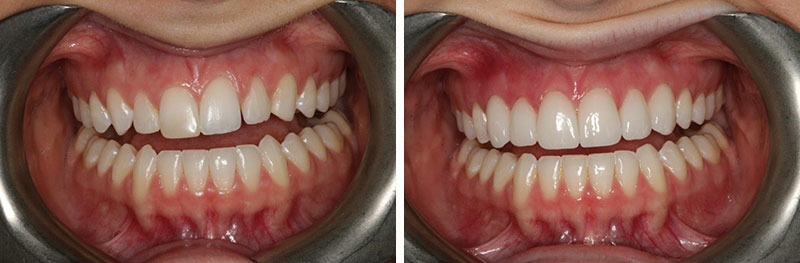 Orthodontics, Bonding, Crown Lengthening and Veneers and Crowns