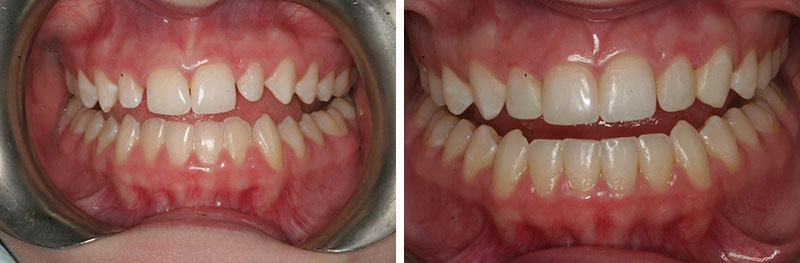 Orthodontics, Bonding, Crown Lengthening and Veneers and Crowns