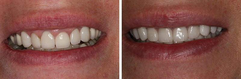 Full Mouth Rehabilitation with Crown Lengthening