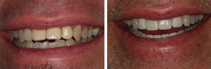 Invisalign, Implant and Front Teeth Crowns