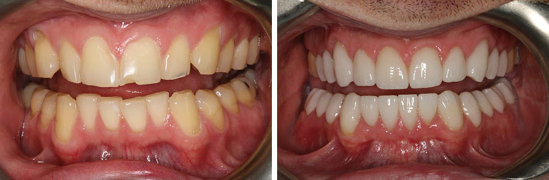 Crowns and Crown Lengthening