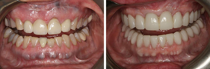 Implant, Grafting, Crown Lengthening and Crowns