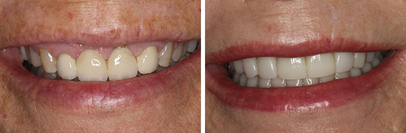 Implant, Grafting, Crown Lengthening and Crowns