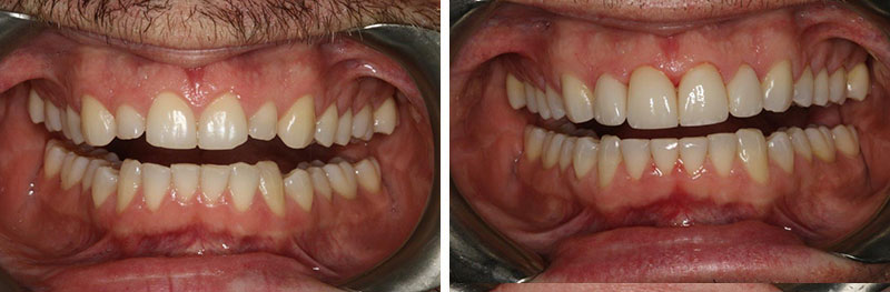 Orthodontics, shaping, porcelain crowns and porcelain veneers