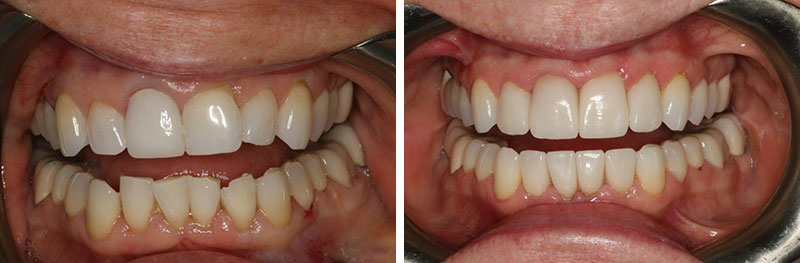 Orthodontics and Anterior Crowns