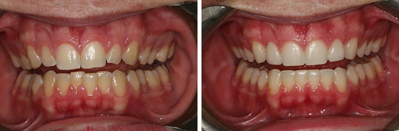 Orthodontics and Veneers