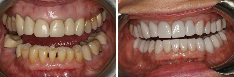 Crowns with Crown Lengthening