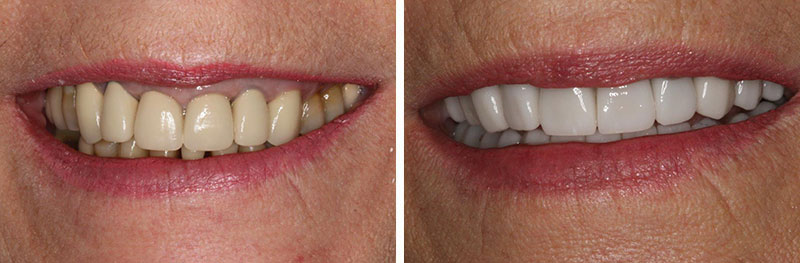 Crowns with Crown Lengthening