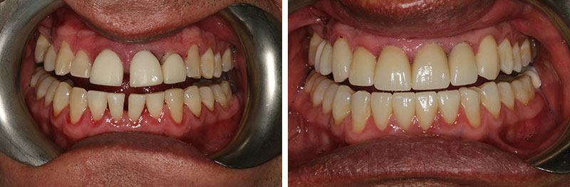 Periodontal Treatment, Crown and Implants