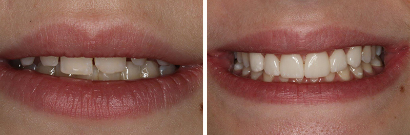Crowns, Veneers and Reshaping of Teeth