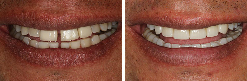 Periodontal Treatment, Crown and Implants