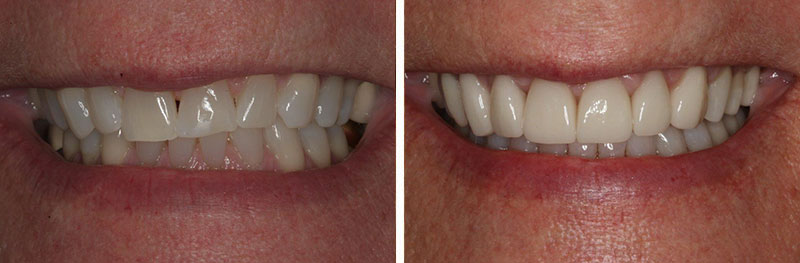 Orthodontics and Porcelain Crowns with Disking