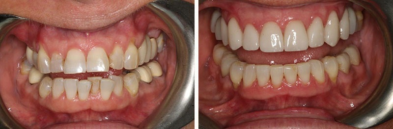 Orthodontics, Crowns and Implants
