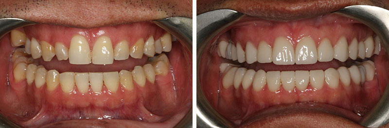 Full Mouth Rehabilitation with Implants