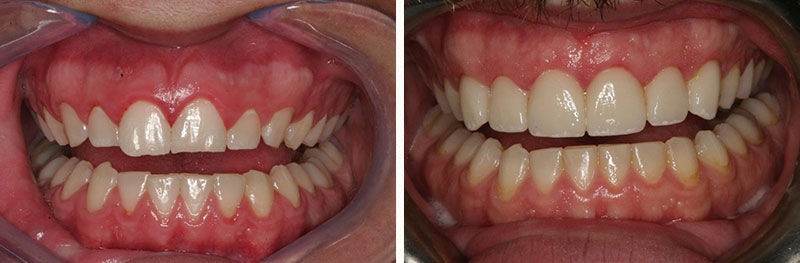 Orthodontics, Veneers and Crowns with Crown Lengthening