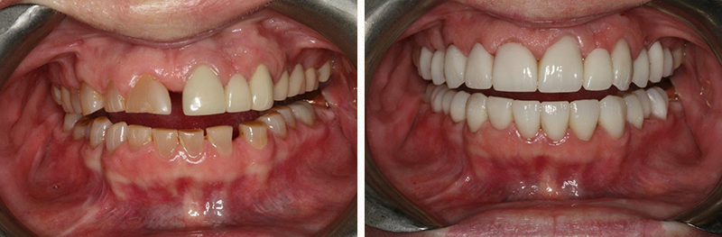 Full mouth reconstruction including two zirconia bridges