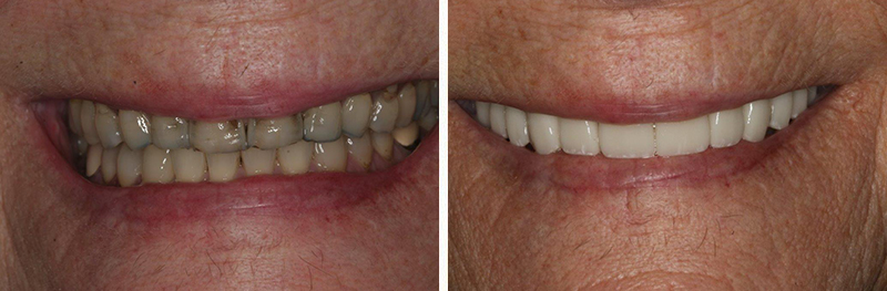 Upper crowns, Bleaching and disking