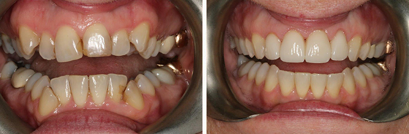 Orthodontics and Porcelain Crowns