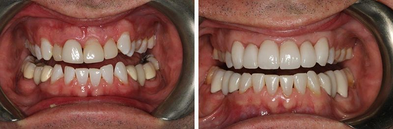 Orthodontics with Crowns and Bridges