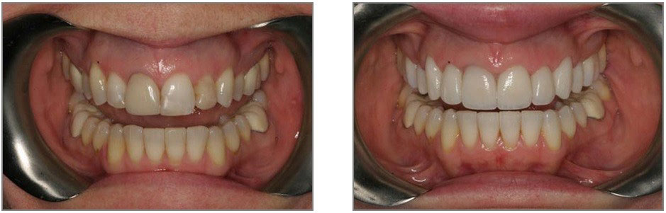 Crown Lengthening and Crowns